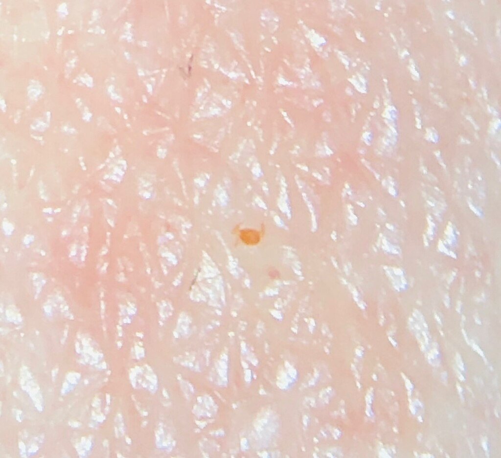 chigger larvae close up on skin